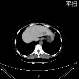 国科大肿瘤医院放射科再填“利器”! 引进高端<font color=red>CT</font> Ingenuity