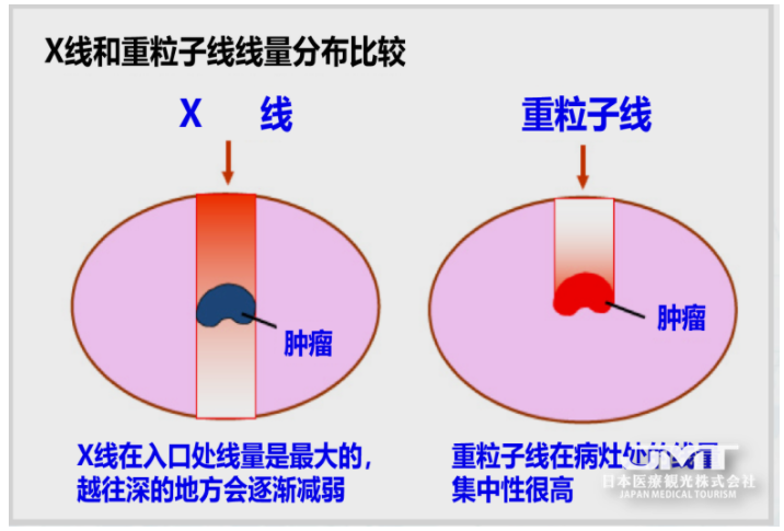 重离子治疗是什么？适合哪些疾病？