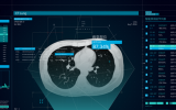 盘点那些耀眼的人工智能CT技术