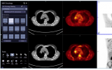 PET/CT下精准肿瘤自动疗效评估