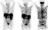 武萍、徐丽：18F-FDG 和68Ga-DOTATATE PET/CT在转移性胰腺神经内分泌肿瘤“超级影像”