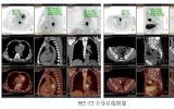 发现恶性肿瘤立即做手术? 先进行PET/CT全身显像检查
