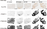 新型Tau PET示踪剂具有高灵敏度和特异性，可识别早期阿尔茨海默病