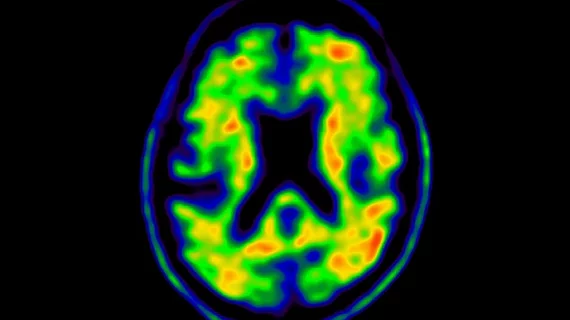 淀粉样蛋白和tau PET成像使用标准十多年后首次更新